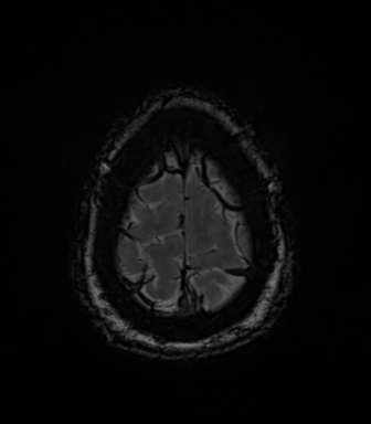 Acoustic schwannoma (Radiopaedia 50846-56358 Axial SWI 86).png