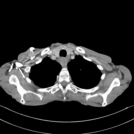 File:Acquired tracheoesophageal fistula (Radiopaedia 57747-65042 Axial C+ portal venous phase 12).jpg