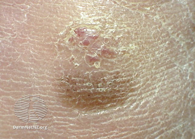File:Acral lentiginous melanoma 2 macro (DermNet NZ alm-1-macro).jpg