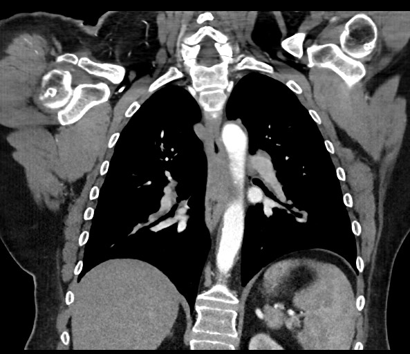 Acromioclavicular joint cyst (Radiopaedia 58455-65610 Coronal C+ arterial phase 93).jpg