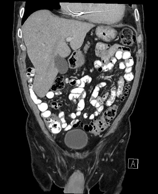 Active lower gastrointestinal bleeding - diverticular (Radiopaedia 61203-69106 Coronal C+ portal venous phase 44).jpg