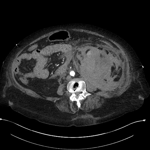 File:Active renal extravasation with large subcapsular and retroperitoneal hemorrhage (Radiopaedia 60975-68796 Axial 17).jpg