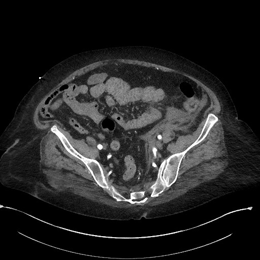 Active renal extravasation with large subcapsular and retroperitoneal hemorrhage (Radiopaedia 60975-68796 Axial C+ arterial phase 150).jpg
