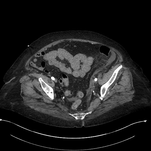 File:Active renal extravasation with large subcapsular and retroperitoneal hemorrhage (Radiopaedia 60975-68796 Axial C+ arterial phase 162).jpg