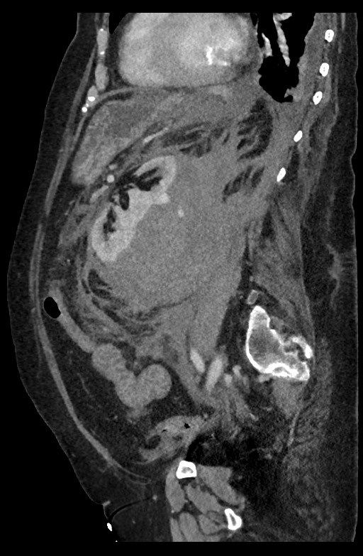 Active renal extravasation with large subcapsular and retroperitoneal hemorrhage (Radiopaedia 60975-68796 Sagittal C+ portal venous phase 92).jpg