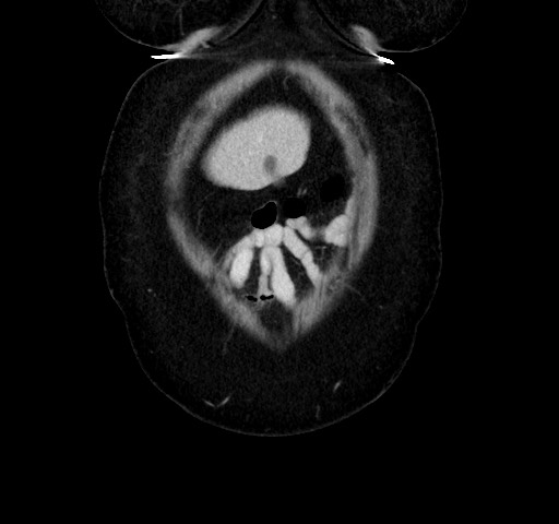 Acute appendicitis, heterotaxy syndrome (Radiopaedia 66884-76202 Coronal C+ portal venous phase 11).jpg