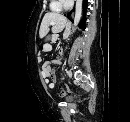 Acute appendicitis, heterotaxy syndrome (Radiopaedia 66884-76202 Sagittal C+ portal venous phase 79).jpg