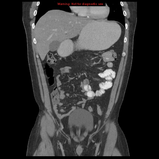 File:Acute appendicitis (Radiopaedia 10498-10973 F 4).jpg