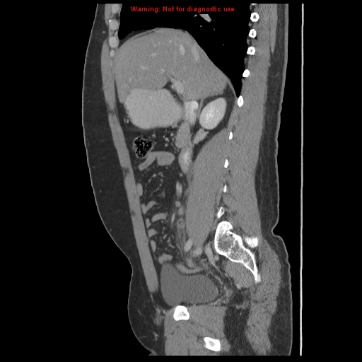 File:Acute appendicitis (Radiopaedia 10498-10973 Sagittal C+ portal venous phase 17).jpg