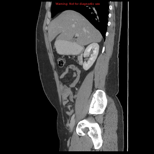 File:Acute appendicitis (Radiopaedia 10498-10973 Sagittal C+ portal venous phase 9).jpg