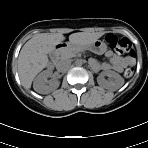 Acute appendicitis (Radiopaedia 30261-30888 Axial non-contrast 20).jpg