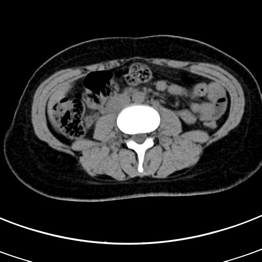 Acute appendicitis (Radiopaedia 30261-30888 Axial non-contrast 42).jpg