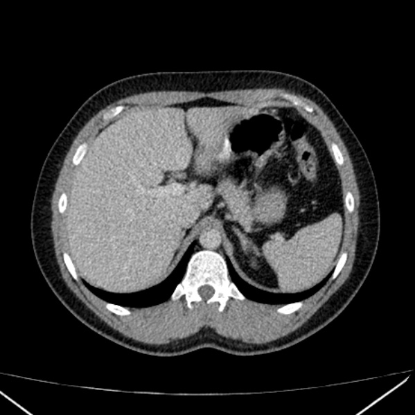Acute appendicitis (Radiopaedia 38255-40270 Axial C+ portal venous phase 22).jpg