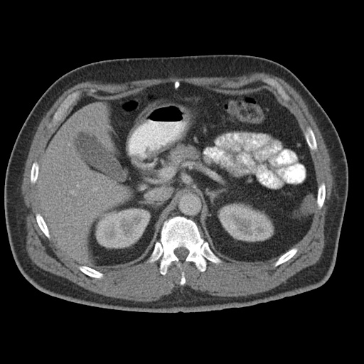 Acute appendicitis (Radiopaedia 48511-53463 Axial C+ portal venous phase 31).jpg