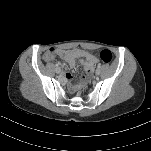 Acute appendicitis (Radiopaedia 62608-70901 Axial C+ portal venous phase 23).jpg