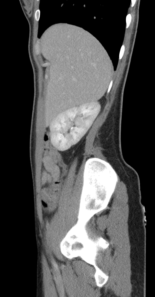 Acute appendicitis (Radiopaedia 62608-70901 Sagittal C+ portal venous phase 47).jpg
