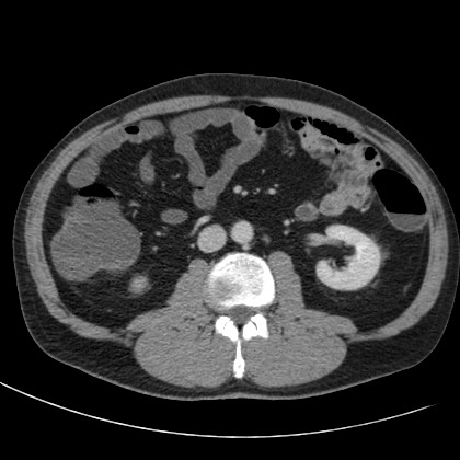 Acute appendicitis (Radiopaedia 66513-75790 Axial C+ portal venous phase 37).jpg