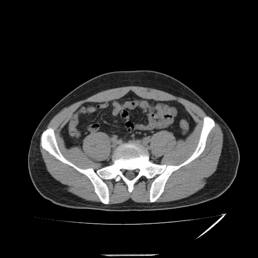 File:Acute appendicitis (Radiopaedia 81320-95015 A 9).jpg