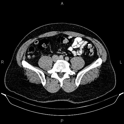 File:Acute appendicitis (Radiopaedia 84780-100240 Axial C+ portal venous phase 73).jpg