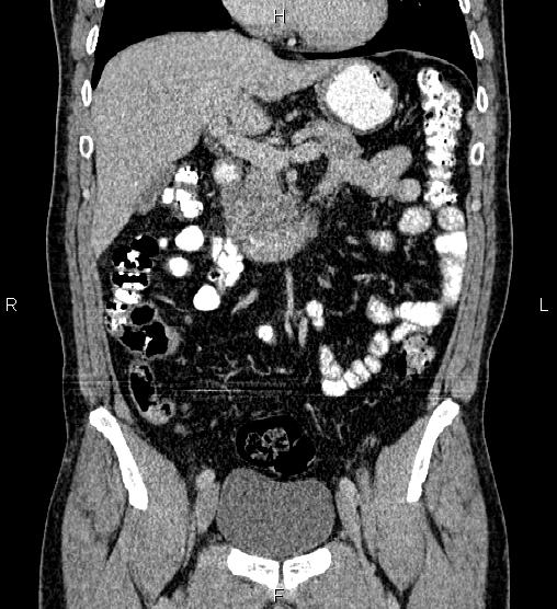 Acute appendicitis (Radiopaedia 84780-100240 Coronal C+ portal venous phase 33).jpg