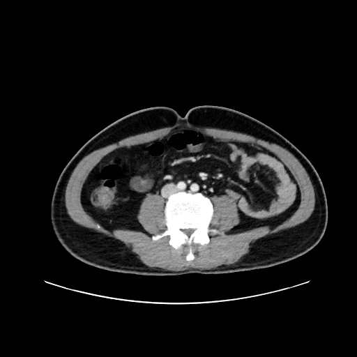 Acute appendicitis and COVID 19 pneumonia (Radiopaedia 76604-88380 Axial C+ portal venous phase 48).jpg