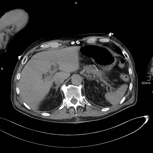 Acute aspiration pneumonitis (Radiopaedia 55642-62166 Axial liver window 59).jpg