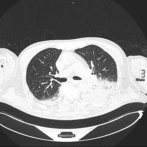 File:Acute aspiration pneumonitis (Radiopaedia 55642-62166 Axial lung window 68).jpg