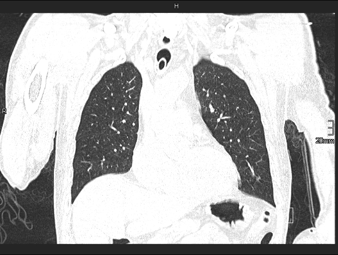 Acute aspiration pneumonitis (Radiopaedia 55642-62166 Coronal lung window 35).jpg