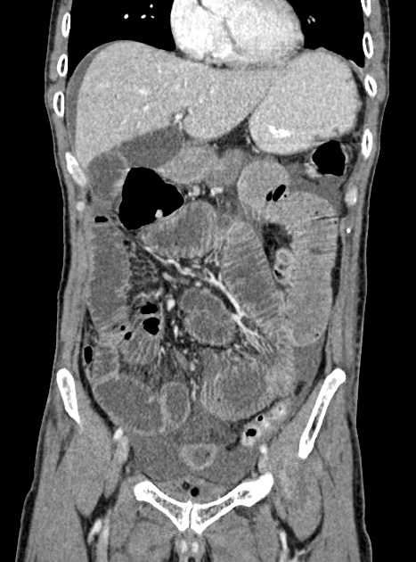 Acute bowel ischemia (Radiopaedia 87695-104114 Coronal C+ portal venous phase 163).jpg