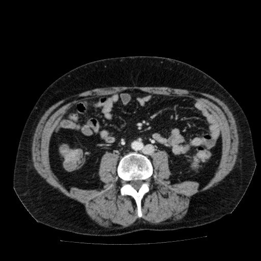Acute cholecystitis and incidental left sided IVC (Radiopaedia 49352-54459 Axial C+ portal venous phase 89).jpg