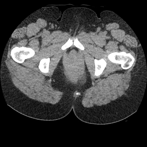 File:Acute cholecystitis and ureteric colic (Radiopaedia 42330-45444 Axial prone 114).jpg
