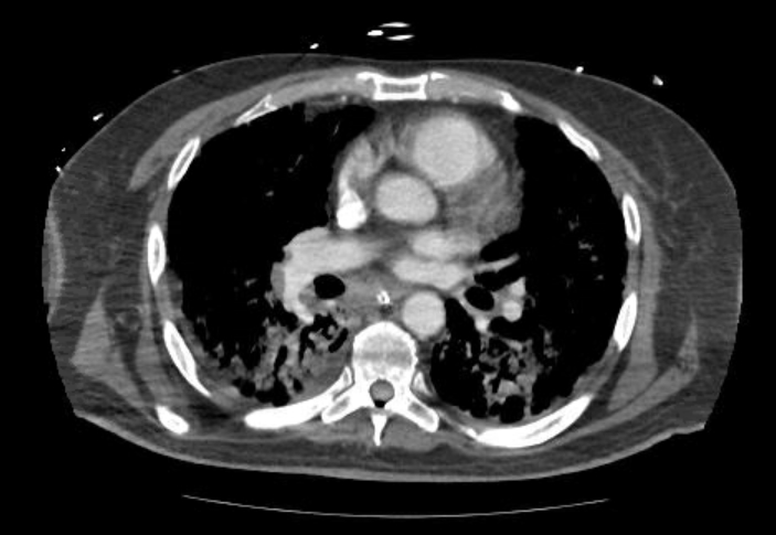File:Acute cor pulmonale (ultrasound) (Radiopaedia 83508-98818 Axial 98).jpg