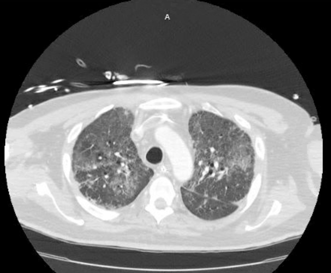 Acute cor pulmonale (ultrasound) (Radiopaedia 83508-98818 Axial lung window 25).jpg