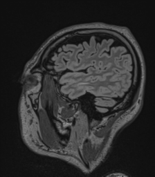 Acute disseminated encephalomyelitis (ADEM)- Anti-NMDA receptor encephalitis (Radiopaedia 54920-61201 Sagittal FLAIR 21).png