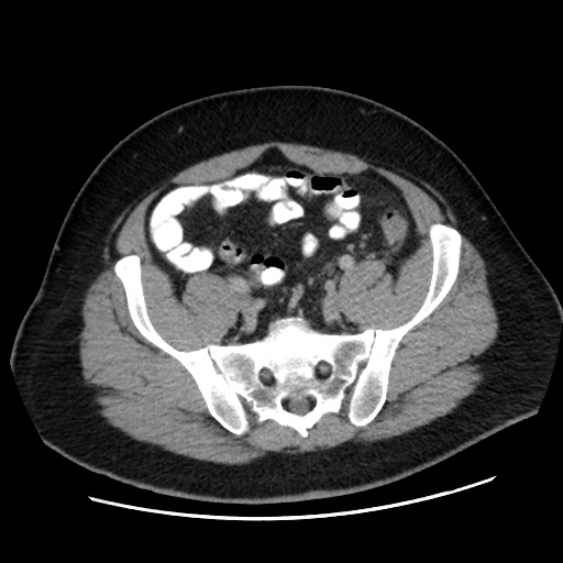 Acute diverticulitis with localized perforation (Radiopaedia 41296-44113 Axial C+ portal venous phase 69).jpg