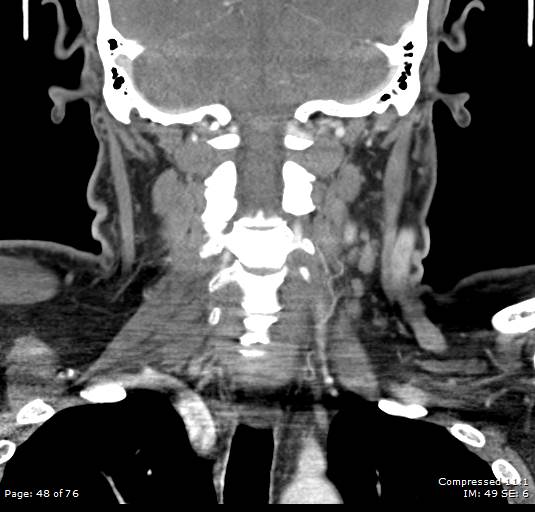 File:Acute epiglottitis (Radiopaedia 54375-60590 Coronal C+ arterial phase 48).jpg
