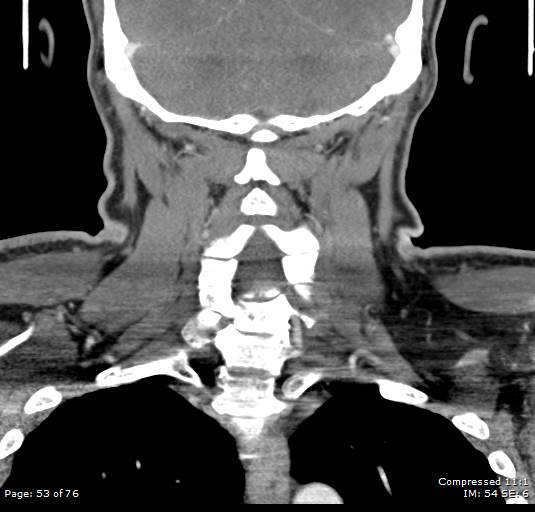 Acute epiglottitis (Radiopaedia 54375-60590 Coronal C+ arterial phase 53).jpg