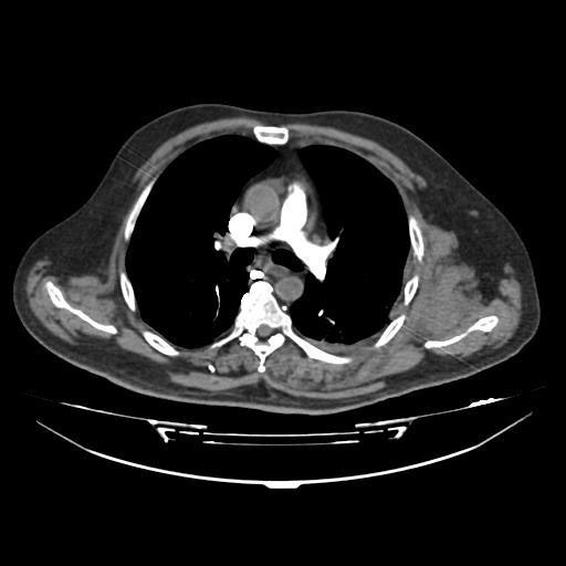 Acute heart failure (CT) (Radiopaedia 79835-93075 Axial C+ arterial phase 4).jpg