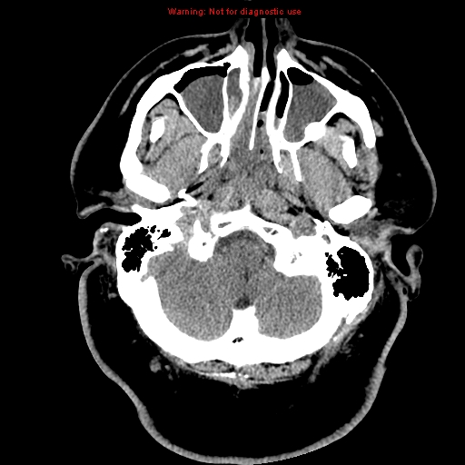 Acute hemorrhagic leukoencephalitis (Radiopaedia 14076-13920 Axial non-contrast 4).jpg