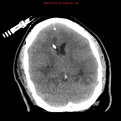 File:Acute hemorrhagic leukoencephalitis (Radiopaedia 14076-72275 Axial non-contrast 20).jpg