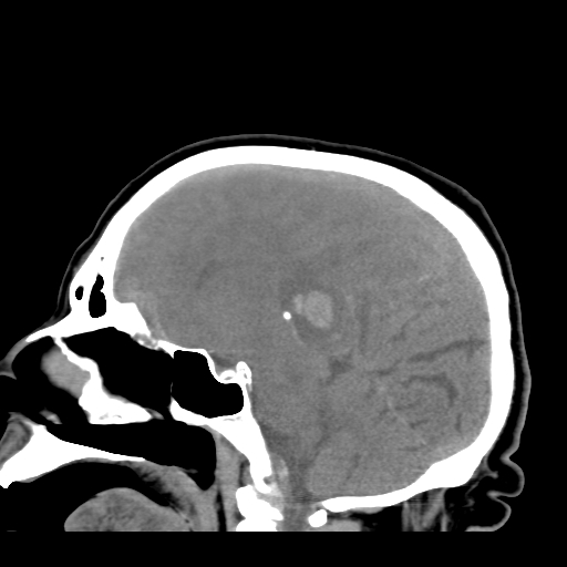 File:Acute hemorrhagic stroke (Radiopaedia 17507-17223 Sagittal non-contrast 24).jpg