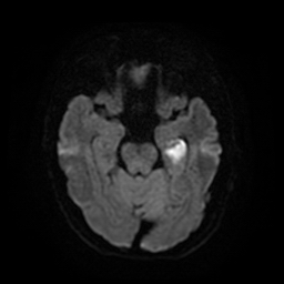 File:Acute hippocampal infarction (Radiopaedia 10610-11072 DWI 2).jpg