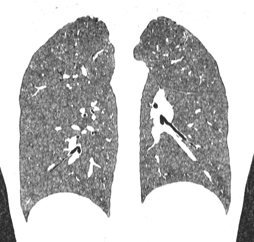 File:Acute hypersensitivity pneumonitis (Radiopaedia 85293-100870 Coronal lung window 87).jpg