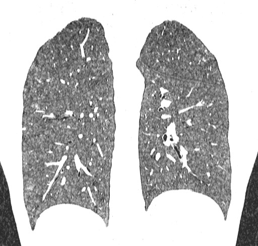 Acute hypersensitivity pneumonitis (Radiopaedia 85293-100870 Coronal lung window 96).jpg