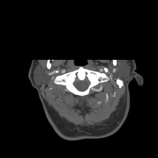 File:Acute internal carotid artery dissection (Radiopaedia 53541-59630 D 2).jpg