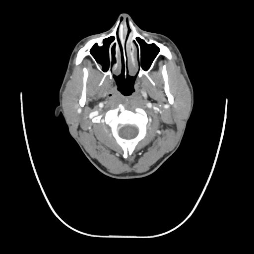 Acute longus colli calcific tendinitis (Radiopaedia 72495-83036 Axial C+ arterial phase 20).jpg