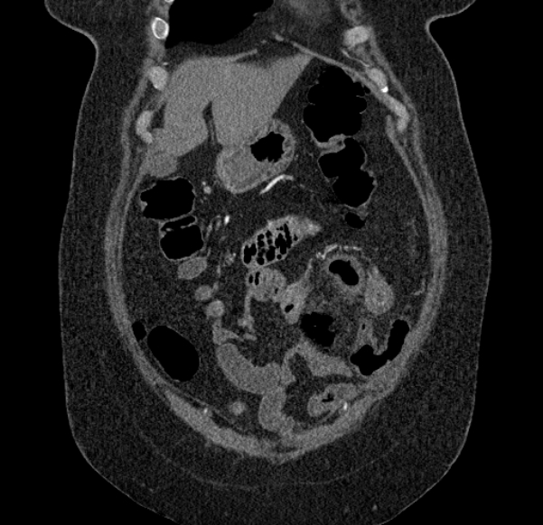 Acute mesenteric ischemia (Radiopaedia 80029-93316 Coronal C+ arterial phase 23).jpg