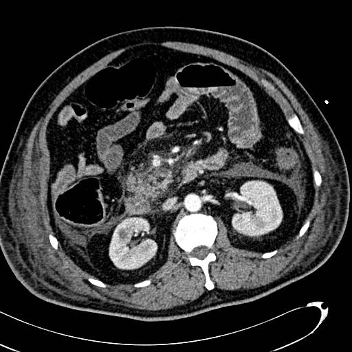 File:Acute pancreatic necrosis (Radiopaedia 13560-13486 Axial C+ portal venous phase 70).jpg