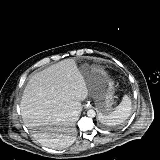 File:Acute pancreatic necrosis (Radiopaedia 13560-18501 Axial C+ portal venous phase 19).jpg