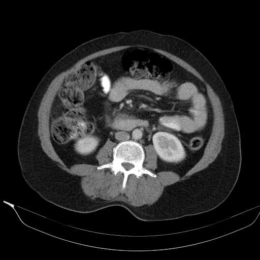 File:Acute pancreatitis (Radiopaedia 20829-20744 Axial C+ portal venous phase 26).jpg